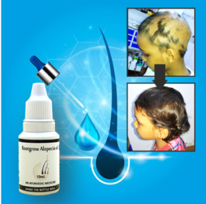 Alopecia Oil